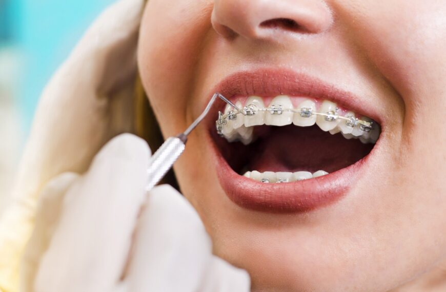 Should I Get Braces