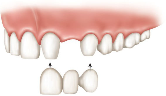 Dental Bridges: Benefits, Types, And Process