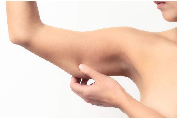All You Need To Know About Arm Lift Surgery