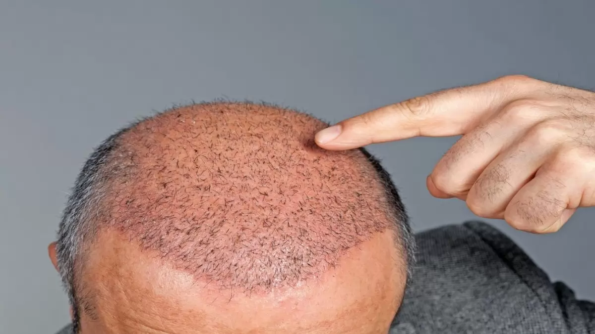 Hair Transplant Turkey How To Choose A Hair Transplant Clinic In Turkey